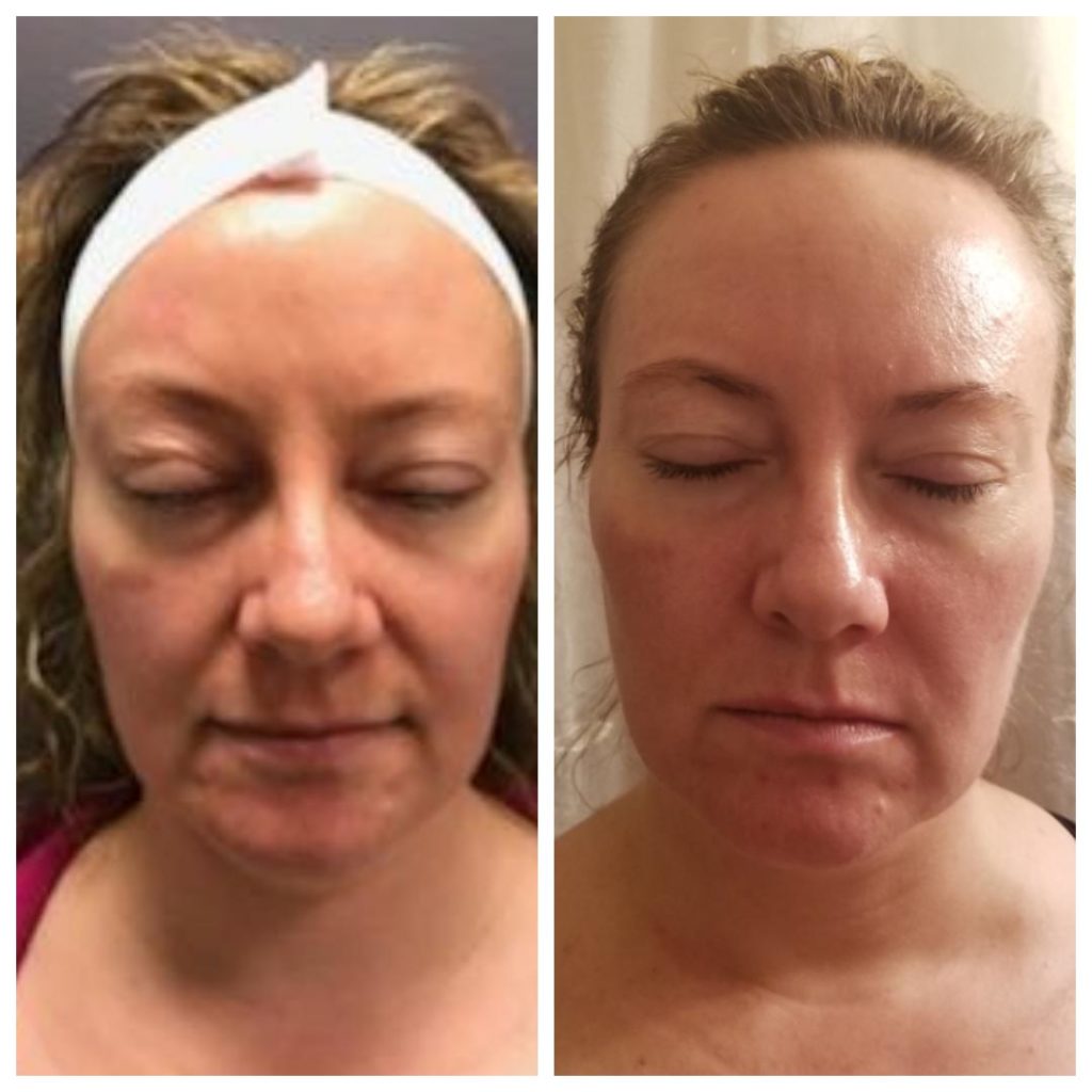 Microneedling results at Uma Clinic Seattle