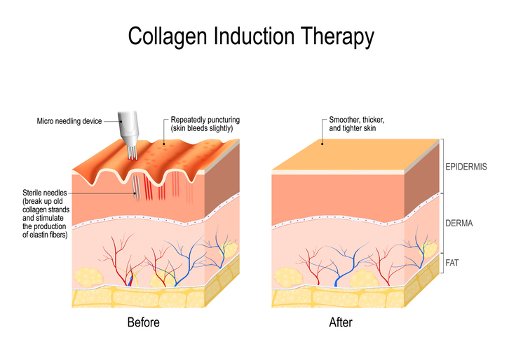 Microneedling - Skin Tightening in Seattle at Uma Clinic. 