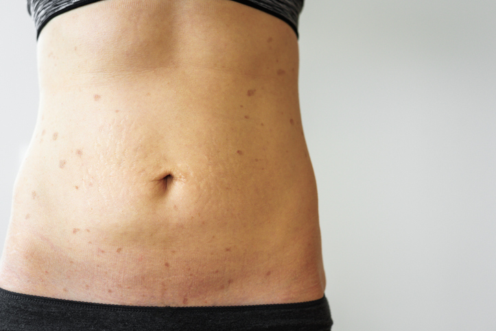 Cavitation- skin tightening- Body contouring in Seattle after lipo for even better results. 