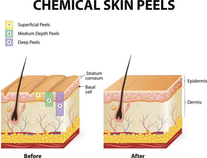 Chemical peel Seattle. Sun Damage, Melasma at Uma Clinic 