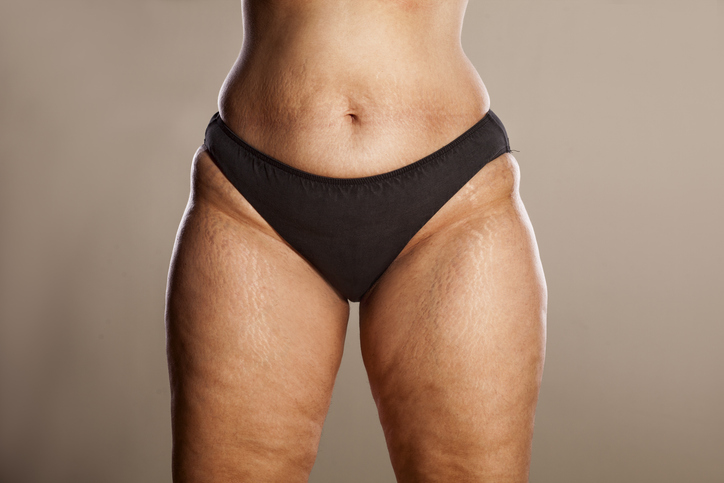 Lipedema Treatment Seattle - Lymphatic Drainage for Lipedema - Lipedema Surgery Recovery