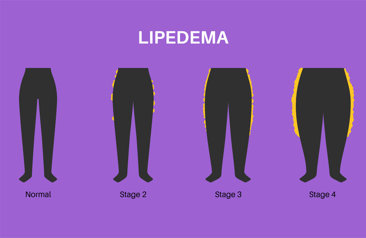 Lipedema treatment Seattle at Uma Clinic. Lymphatic Drainage for Lipedema Seattle. 