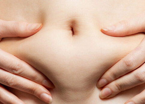 A woman holds her hands to her stomach, pulling the skin with fat. Close-up of the abdomen and navel