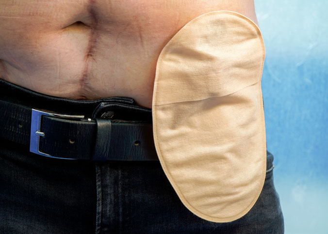 Adult-man-in-jeans-with-an-ostomy-bag-1421967392_727x484