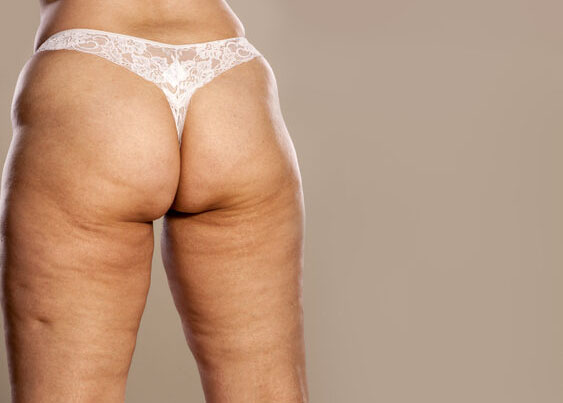 Fat female buttocks with cellulite and stretch marks
