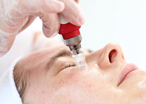 Microneedle mesotherapy, treatment woman at the beautician
