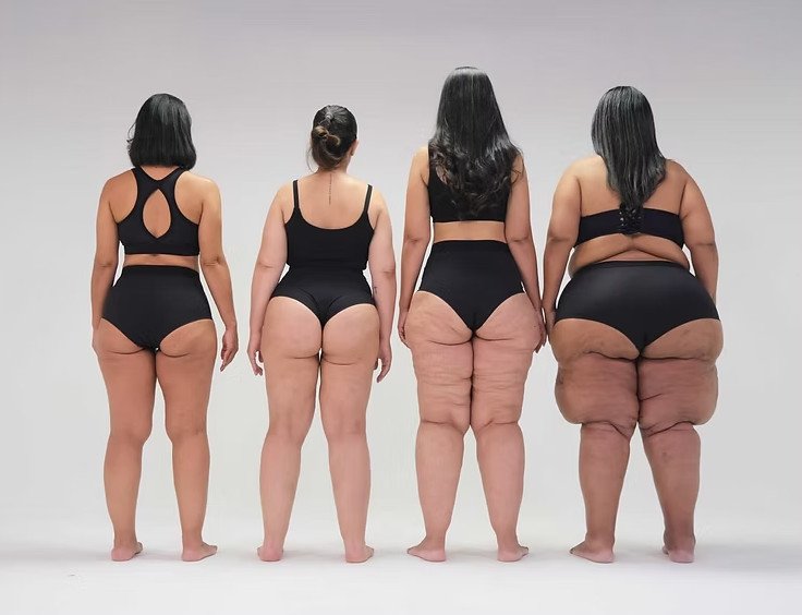 Lipedema supportive care at UMA Clinic