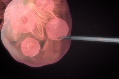 Lymphatic Drainage for IVF-In Vitro Fertilization. Lymphatic drainage for fertility. Lymphatic Drainage for Egg Retrieval.